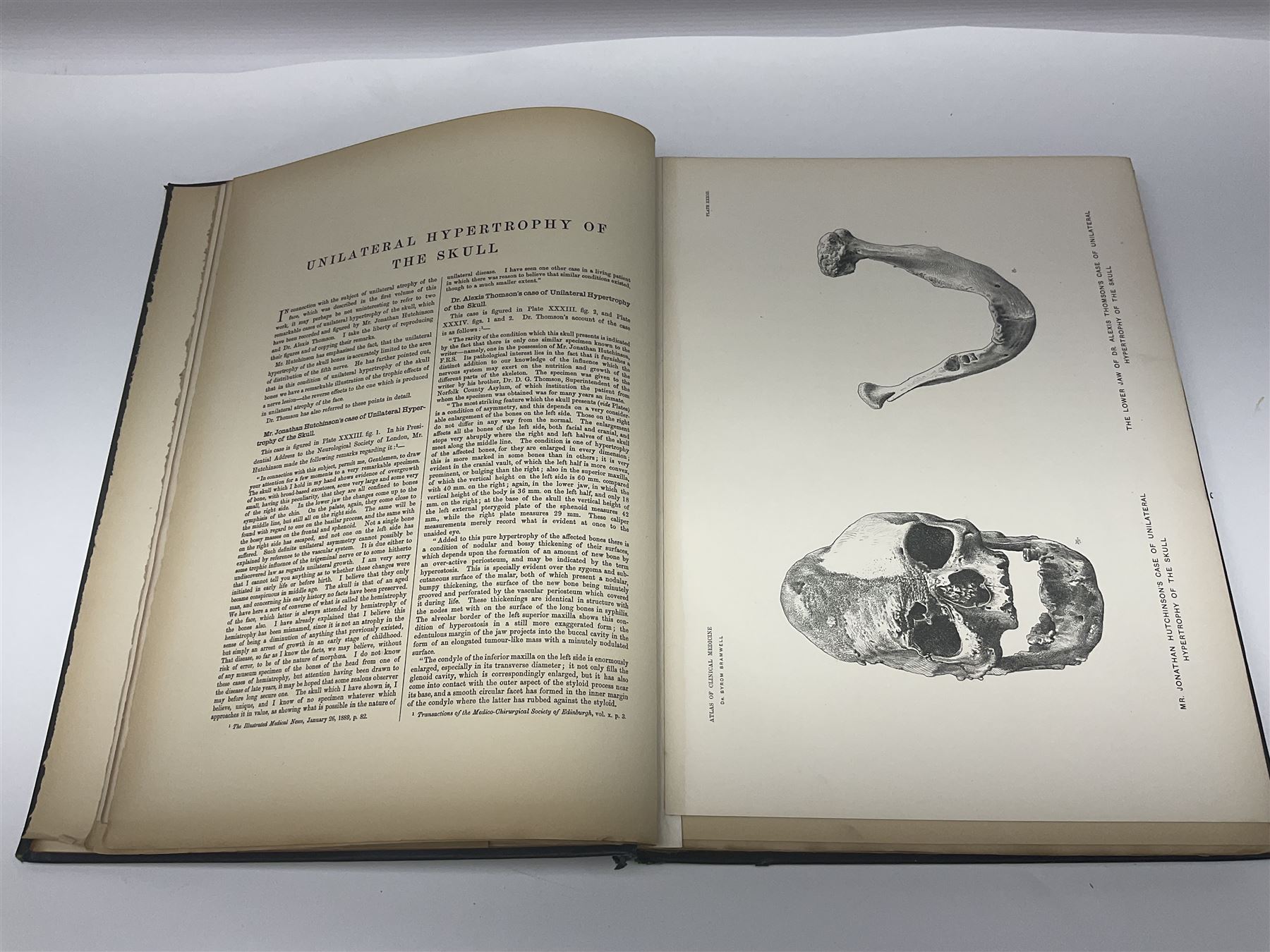 Bramwell, Byrom: Atlas of Clinical Medicine; three volumes, Edinburgh, printed by T & A Constable at the University Press, 1892-96, with numerous colour and black and white illustrations