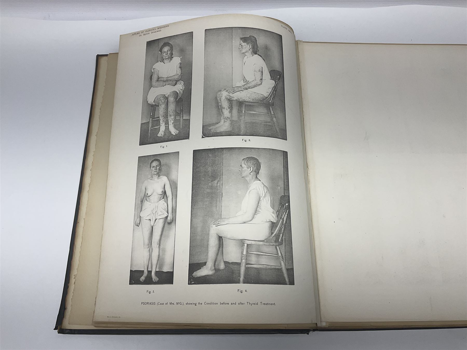 Bramwell, Byrom: Atlas of Clinical Medicine; three volumes, Edinburgh, printed by T & A Constable at the University Press, 1892-96, with numerous colour and black and white illustrations
